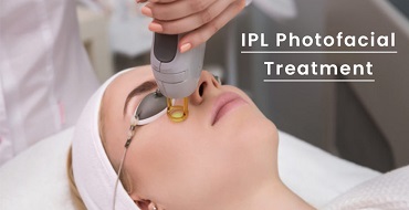IPL Photofacial Treatment